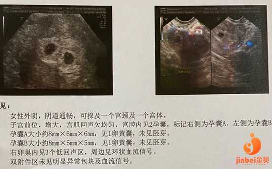 昆明供卵正规中心, 三代试管艰辛全过程 双胎出胎心胎芽_上海试管供卵代怀医
